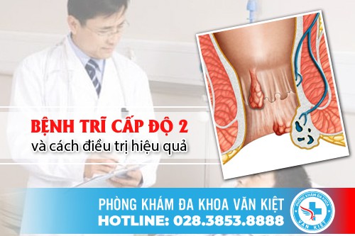 Bệnh trĩ cấp độ 2 và cách điều trị hiệu quả