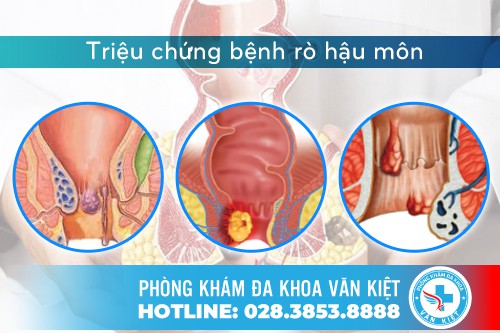 Triệu chứng của bệnh rò hậu môn
