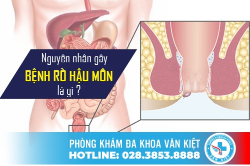 Nguyên nhân gây bệnh rò hậu môn là gì?