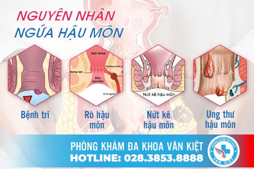 Ngứa rát hậu môn là dấu hiệu cảnh báo đã mắc phải bệnh gì? Cách điều trị bệnh ngứa hậu môn hiệu quả