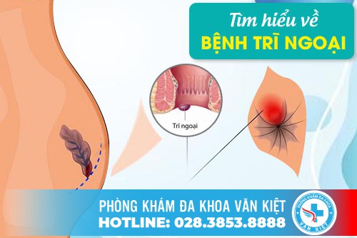 Những lưu ý về bệnh trĩ ngoại mà người bệnh cần phải biết? Cách điều trị trĩ ngoại hiệu quả nhất hiệu nay là gì?