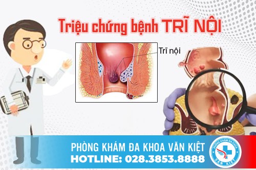 Triệu chứng dấu hiệu nhận biết bệnh trĩ nội