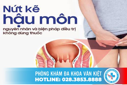 Nứt kẽ hậu môn - Nguyên nhân và Cách điều trị hiệu quả