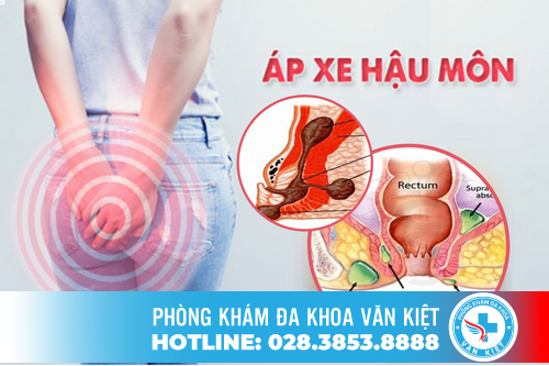 Apxe hậu môn là bệnh gì? nguyên nhân và cách chữa trị hiệu quả