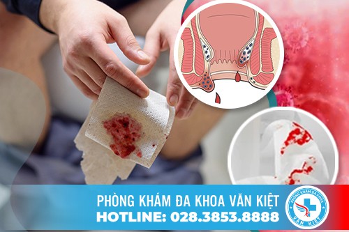 Đại tiện ra máu tươi kèm chất nhầy và đau rát hậu môn là dấu hiệu bệnh gì? Có nguy hiểm không?