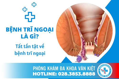 Bệnh Trĩ Ngoại Là Gì, Tìm Hiểu Tất Tần Tật Về Bệnh Trĩ Ngoại