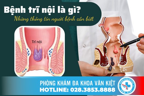 Bệnh trĩ nội là gì? Những thông tin người bệnh cần biết