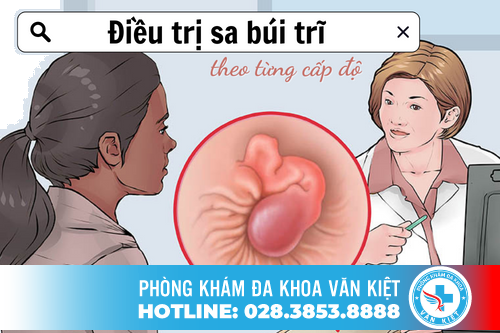 Điều trị sa búi trĩ theo từng cấp độ