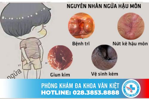 Ngứa rát hậu môn là bệnh gì?
