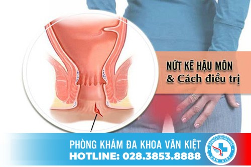 Điều trị nứt kẽ hậu môn như thế nào hiệu quả?